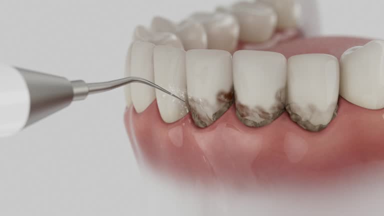 Trusted Wisdom Tooth Removal service in Miller, SD - Dentist Open Now